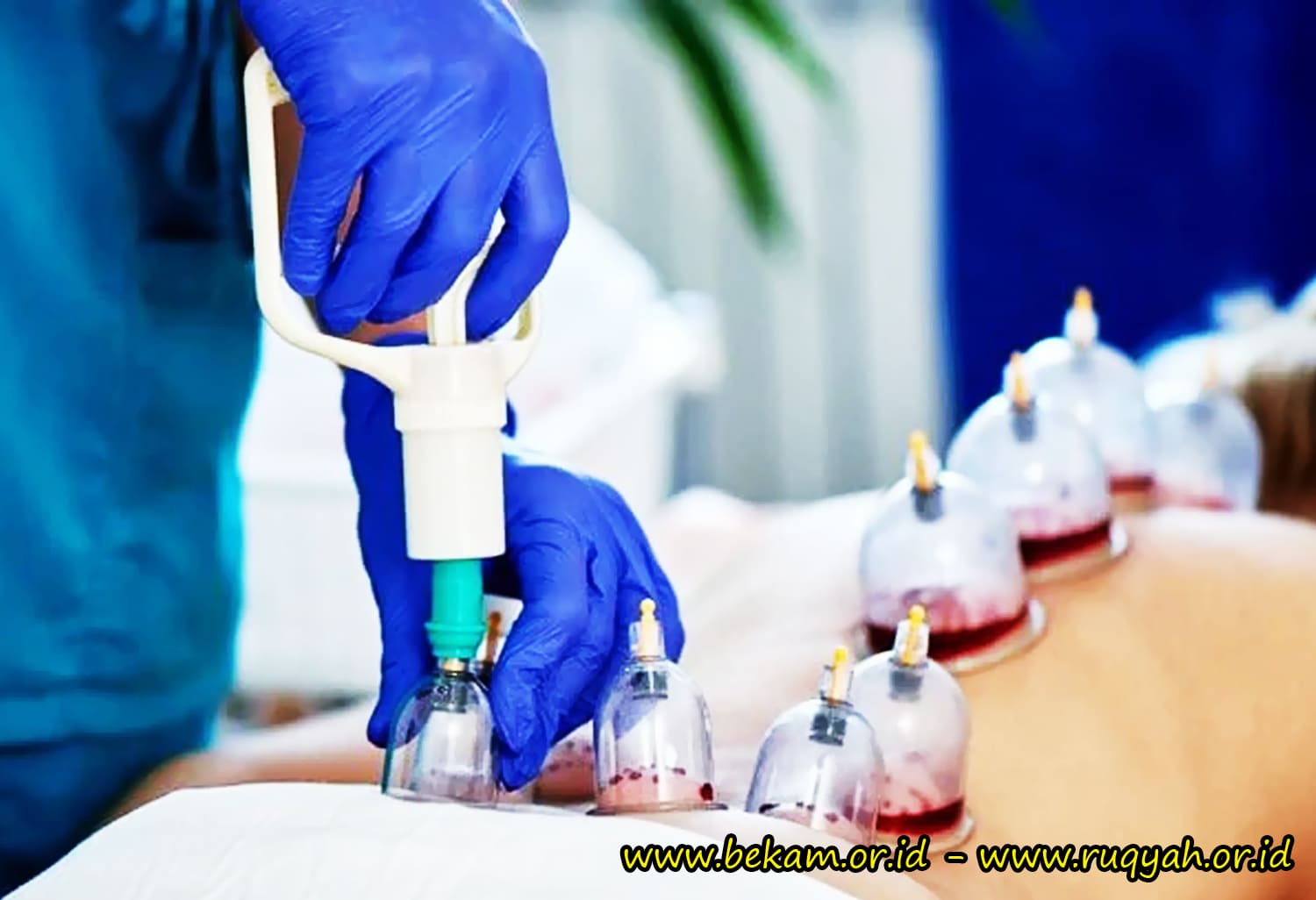 Bekam Batam Sangat Efektif untuk Pengobatan Asam Urat Diabetes Ginjal dan Jantung