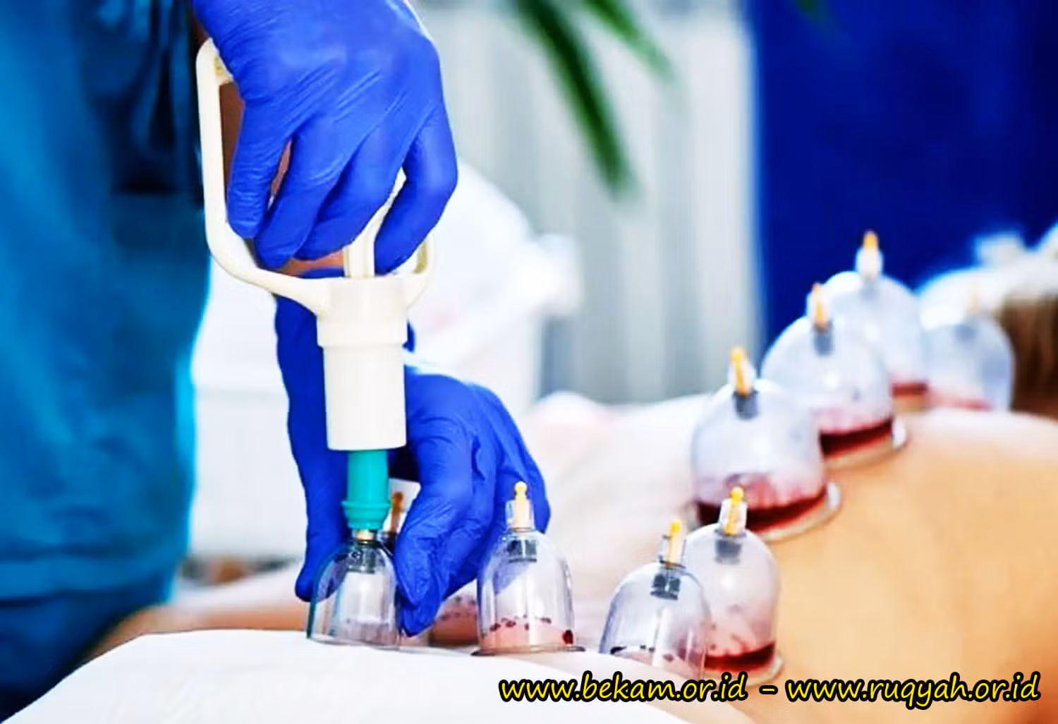 Bekam Batam Sangat Efektif untuk Pengobatan Asam Urat Diabetes Ginjal dan Jantung