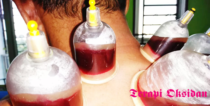 Anomali hasil darah bekam dengan teknik goresan (sayatan) di tempat bekam Bengkel Manusia Indonesia