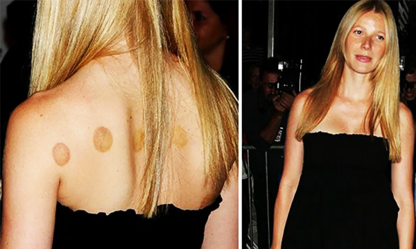 Ketika Victoria Beckham Berbekam