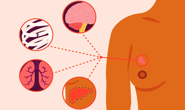Benjolan Payudara Tidak Selalu Tumor