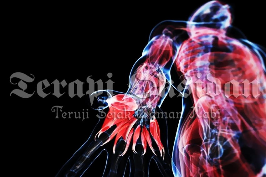 Bekam Bisa Obati 100 Penyakit