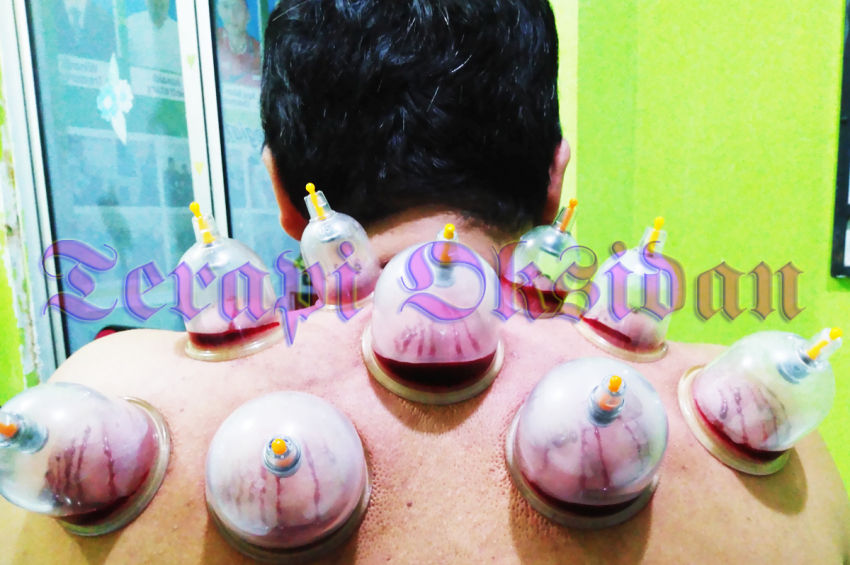 Does Wet Cupping Remove Toxins